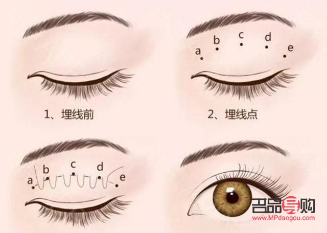 新月形雙眼皮特點(diǎn)圖片(新月形雙眼皮特點(diǎn)圖片)