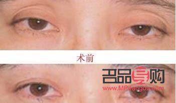 眼皮下垂怎么自然恢復吃什么好(眼皮下垂怎么做會改善)