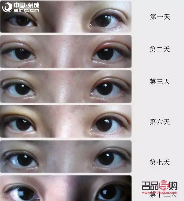什么雙眼皮恢復期最快(什么雙眼皮恢復期最快呢)