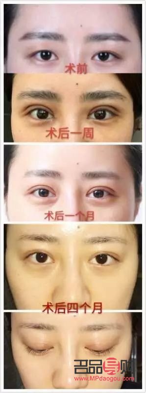 什么雙眼皮恢復期最快(什么雙眼皮恢復期最快呢)