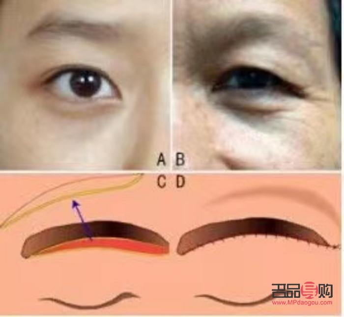雙眼皮下垂怎么自然恢復視頻(雙眼皮下垂怎么自然恢復視頻教程)