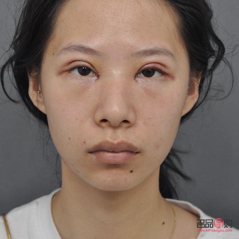 雙眼皮手術(shù)哪家強(qiáng)？專業(yè)醫(yī)院助你實現(xiàn)電眼魅力