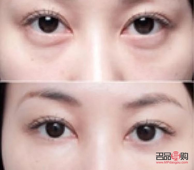眼袋與臥蠶的區(qū)別圖片對(duì)比：了解差異，打造美麗眼部