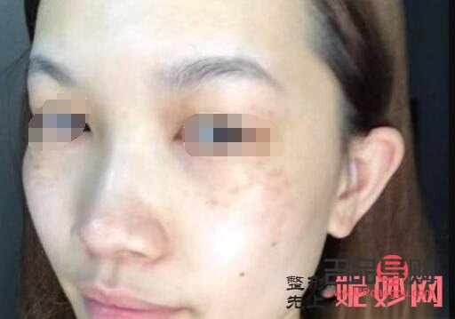 <h3>美容祛斑要多少錢？全面解析祛斑費用及影響因素</h3>