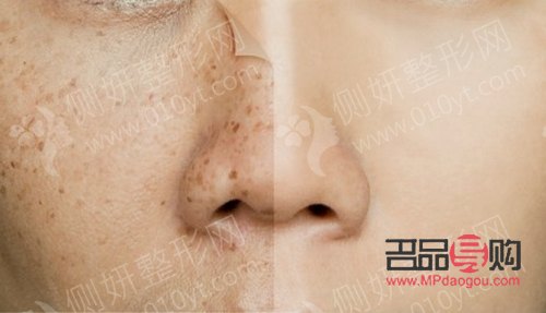 美容祛斑要多少錢？全面解析祛斑費(fèi)用及影響因素