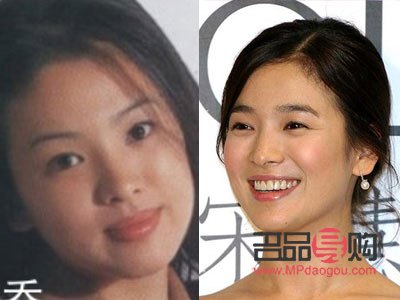 <h3>平行雙眼皮圖片前后對比圖大揭秘，打造迷人電眼新境界！</h3>